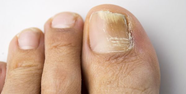 cuidados com unhas quebradiças