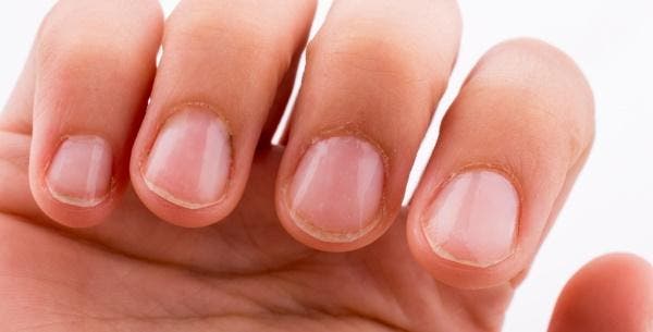 unhas descamando causas e tratamento